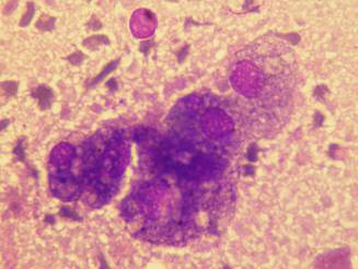 Macrofago alveolar con su citioplasma ocupado por vacuolas lipdicas